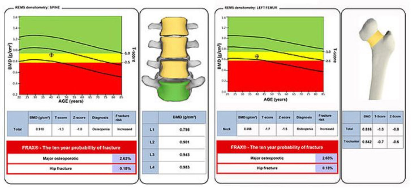 Osteoscan Results